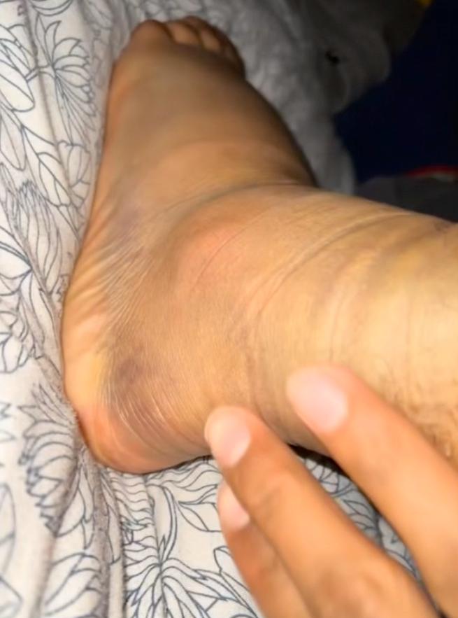 Umar deler sin erfaring etter opptrening med Ankle Trainer