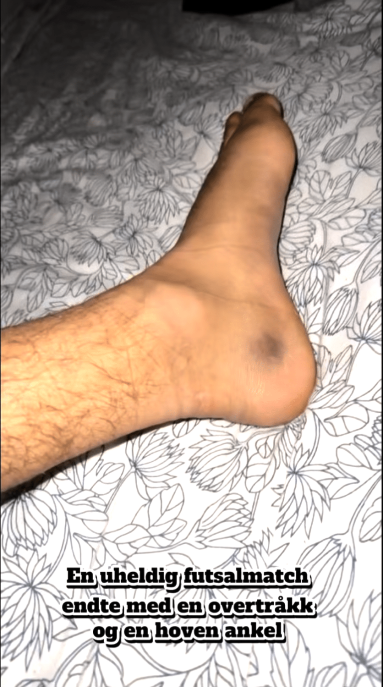 Umar Deler Sin Erfaring Etter Opptrening Med Ankle Trainer